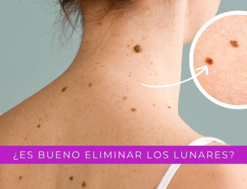 ¿Es bueno eliminar los lunares?