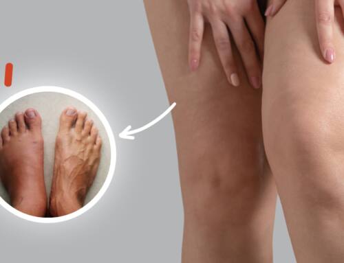 ¿Cómo eliminar la retención de líquidos?